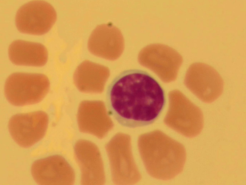 Cerebrospinal fluid cell morphology Cerebrospinal fluid cell morphology